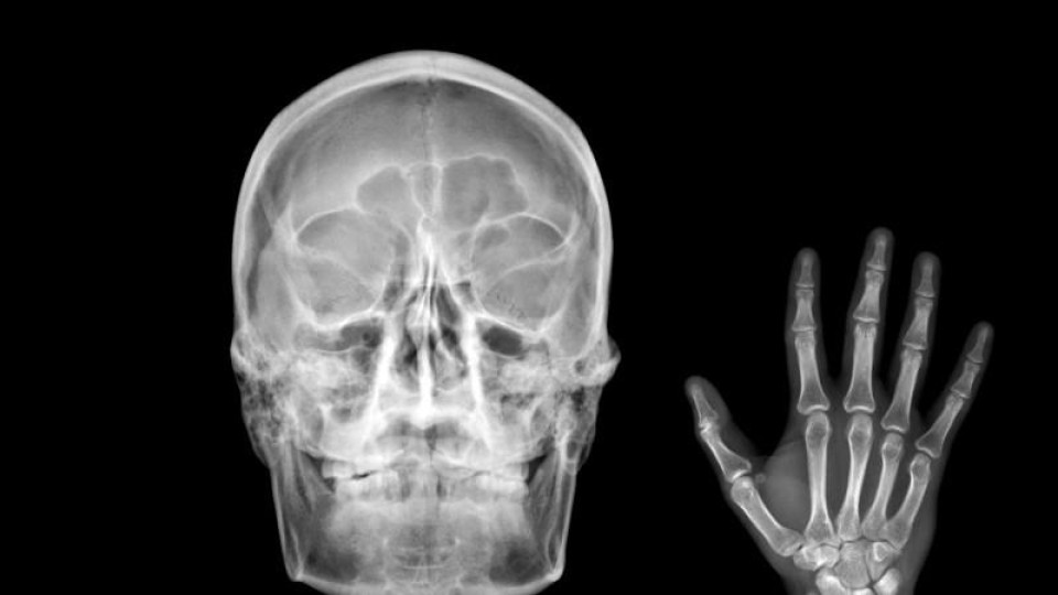 röntgenfoto schedel hand